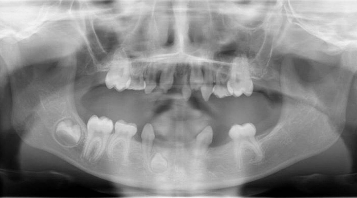 25 Facts About Odontomicronychial Dysplasia 