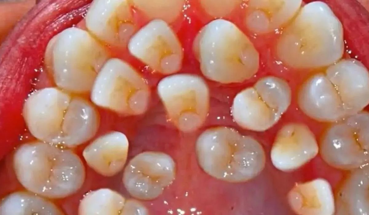 25 Facts About Hyperdontia 