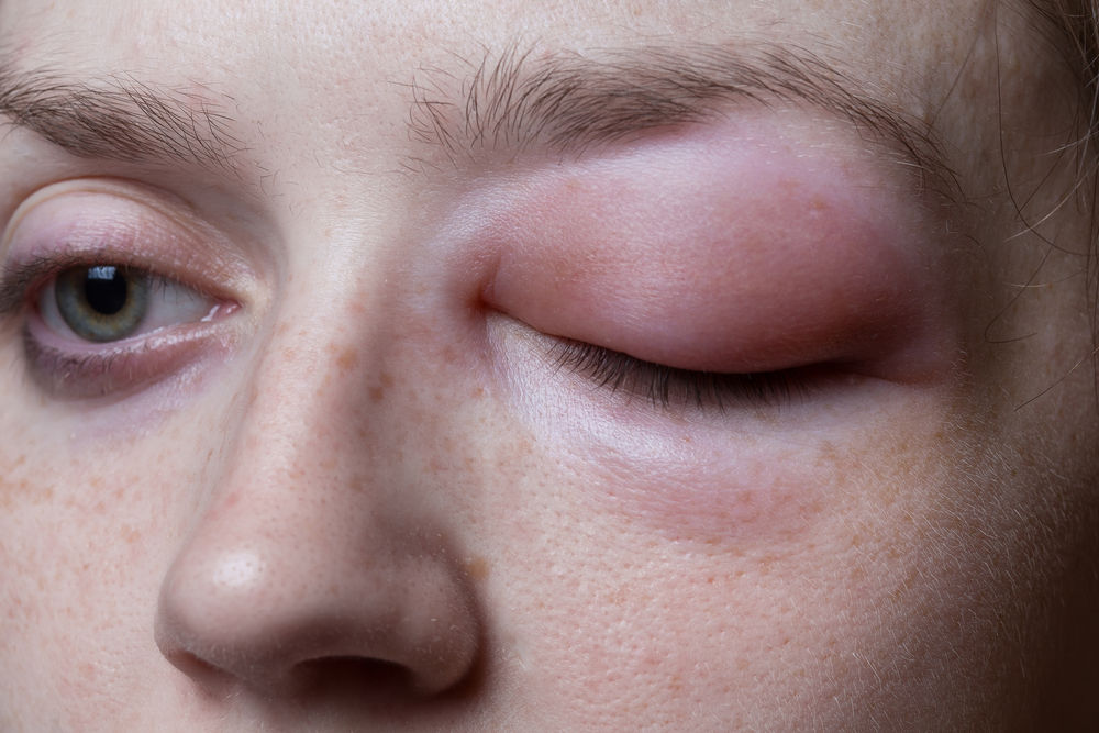 Face Allergic Reaction Vitamin C Allergy at Guadalupe Robinson blog